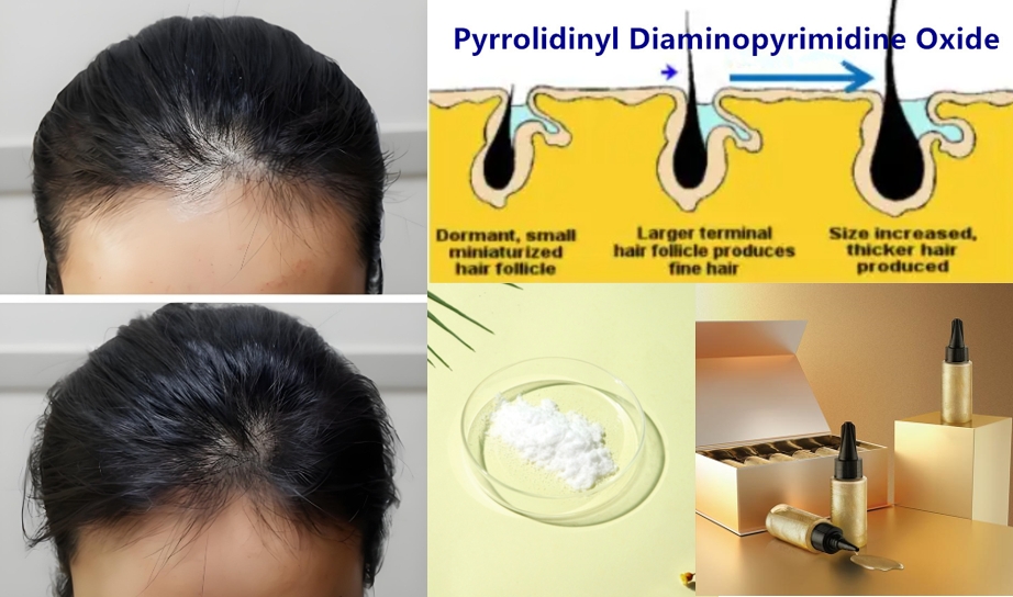 pyrrolidinyl Diaminopyrimide oxide anti-hair loss